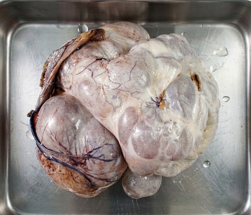 Silent giant ovarian tumour.