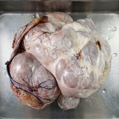 Silent giant ovarian tumour.